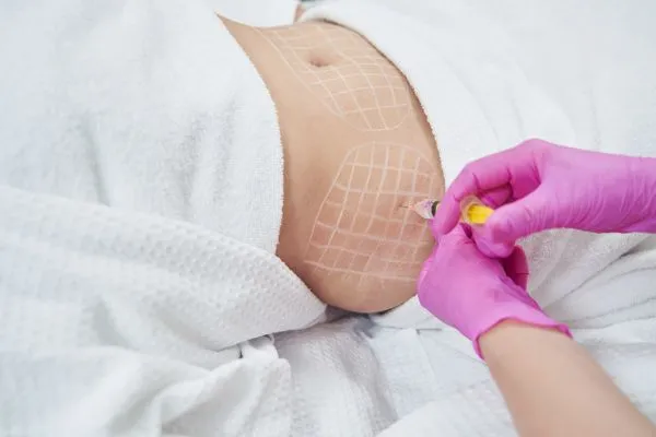 image of fat dissolving injections on love handles to help combat weight gain Barr Common