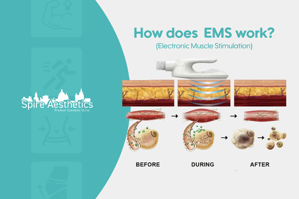EMS treatment for post pregnancy weight loss treatment Barr Common