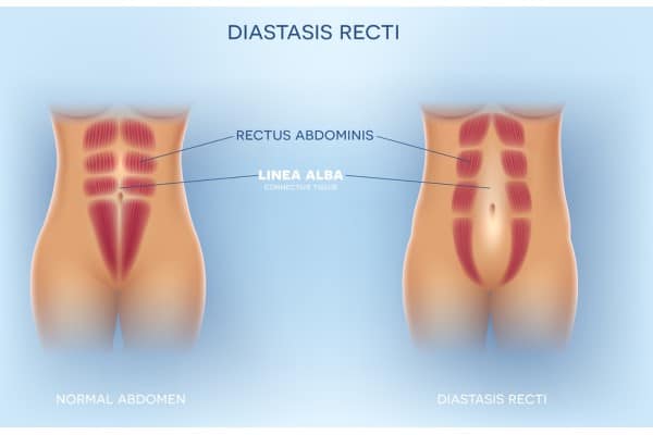 What Non-Surgical Options Are Available for Diastasis Recti Barr Common?