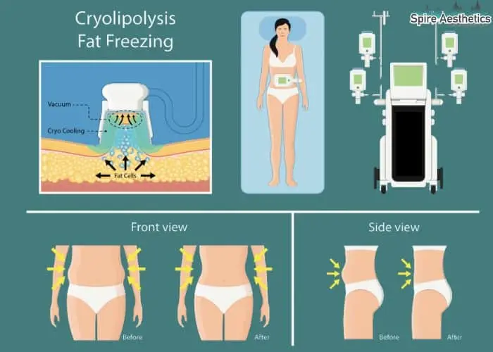 Fat freezing treatment Barr Common benefits for competitions to remove stubborn fat deposits.