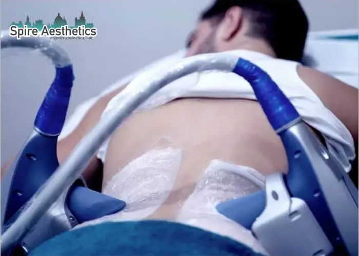 Man having fat freezing treatment done on love handles before a competitions Barr Common to create a sculpted look.