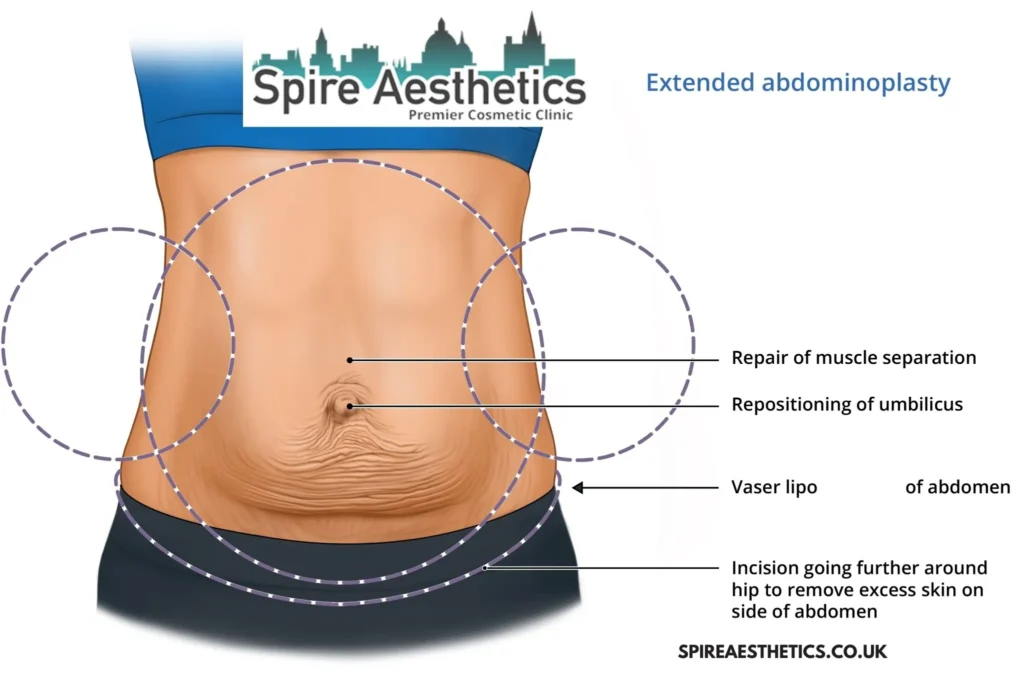 Understanding Loose Skin After Gastric Band Barr Common Surgery and HIFU Treatment