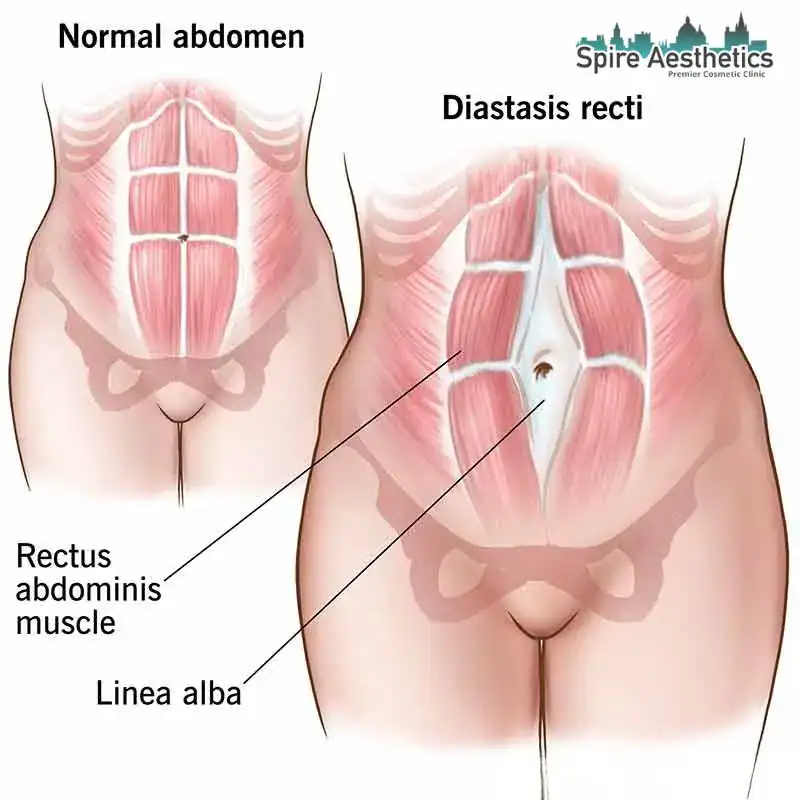 When Will My Belly Feel Normal Again Barr Common?